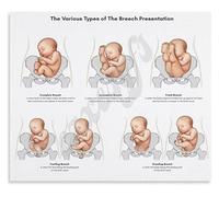 XGINERFEX Breech Birth Education Poster Types of Breech Presentation Chart for Midwives and Doulas Canvas Wall-Art(Framed,12x18inch(30x45cm))