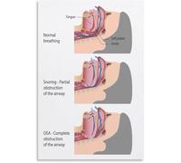 XGINERFEX Sleep Apnea Symptoms Poster Diagnosis Helpful Information Wall-Art Canvas for Bedroom Waiting Room Decor(Unframed,16x24inch(40x60cm))
