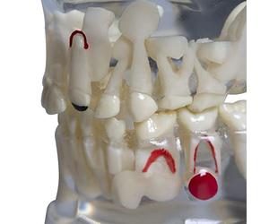 Xiaoxu Modèle Dentaire Transparent pour Dents Malades, modèle Dentaire Transparent pour Enfants présentant des Dents primaires et des Dents de Lait à des Fins pédagogiques et de démonstration.
