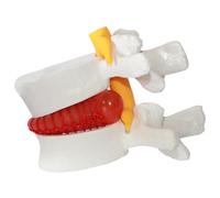 XJKLBYQ Herniated Disc Model, PVC Human Lumbar Vertebrae Disc Model, 1, 5X Grandeur Nature de l'enseignement de la Colonne vertébrale pour l'apprentissage, démonstration