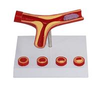YHNNH, Modèle cardiovasculaire d'athérosclérose Humaine, modèle Anatomique de Vaisseau sanguin, modèle de Thrombus for Fournitures d'enseignement médical
