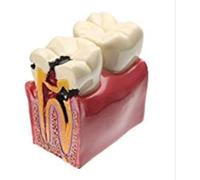 Youya - Modèle de dents de caries dentaires - 6 fois