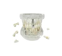 Youya - Modèle de dents de maladie transparent - Modèle d'implant dentaire transparent - Modèle d'implant dentaire standard pour dentiste - Modèle d'enseignement pathologique