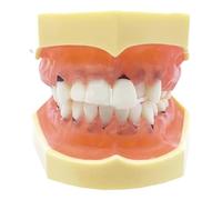 YRQMGSF Modèle de typodont de Dents dentaires, modèle de Classification parodontale pour la parodontopathie, Outil d'explication pour l'enseignement des Maladies parodontales