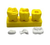 YRQMGSF Modèle d'Inlay Amovible - Modèle de Démonstration des Inlays Postérieurs Élevés - pour la Communication avec Les Patients Cadeaux pour Dentistes