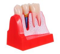 Zerodeko Modèle de Dentier Implant Agrandi pour Démonstration de Couronne et Bridge Outil Pédagogique pour Étudiants et Éducation Patient