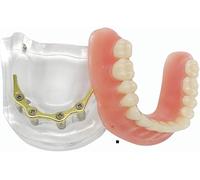 ZWDCVFGK Modèle d'implant Oral Dentaire Dents mandibulaires Implant à 4 Ongles Modèle d'affichage de Communication médecin-Patient