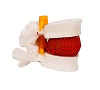 ZXCVBAS 1: 1.5 Hernie Discale Lombaire Humaine en Plastique Modèle De Démonstration Médicale Modèle De Colonne Vertébrale Lombaire Modèle De Disque Lombaire Humain pour l'enseignement Linéaire
